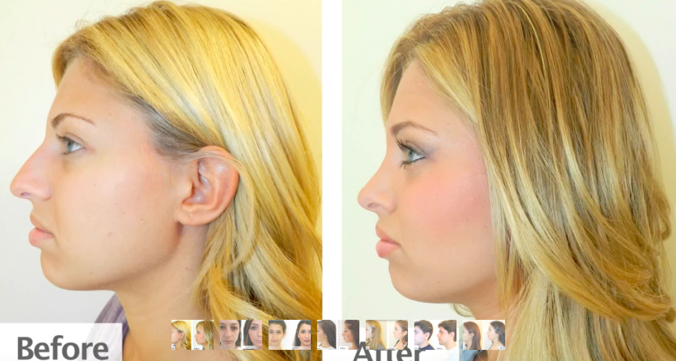best rhinoplasty surgery and famous top specialist surgeon including cost and prices from Dr. Garo Kassabian in Beverly Hills, CA 90210
