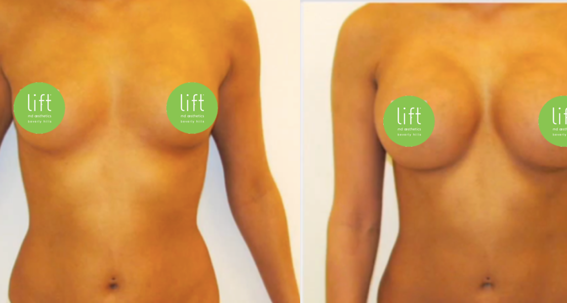 Breast Augmentation