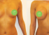 Breast Augmentation