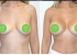 Breast Augmentation