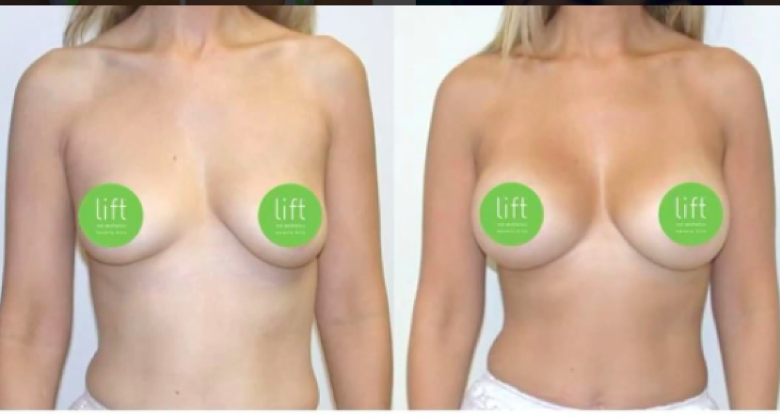 Breast Augmentation