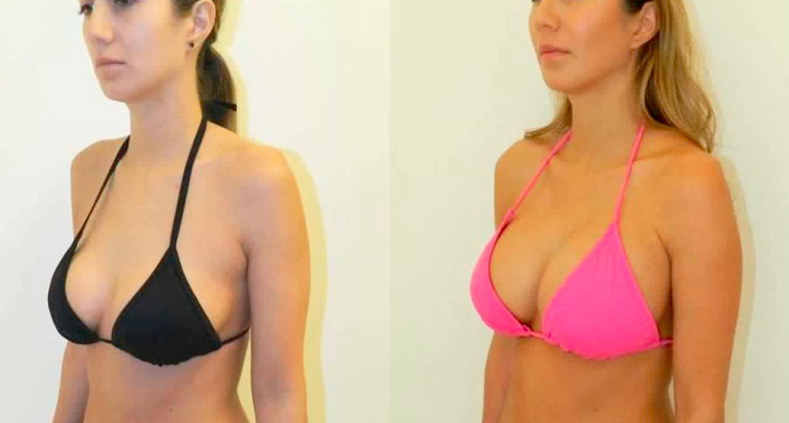 Breast Augmentation