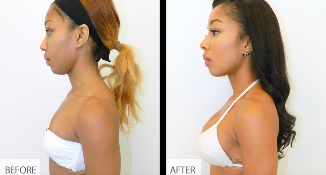 Breast Augmentation