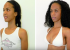 Breast Augmentation