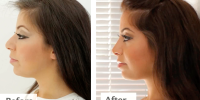 Rhinoplasty