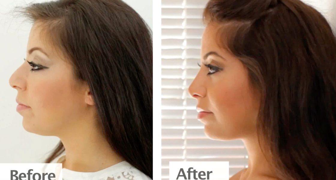 Rhinoplasty