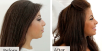 Rhinoplasty