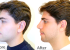 Rhinoplasty