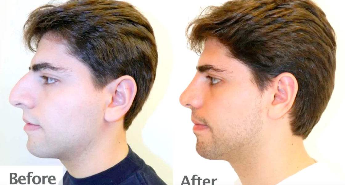 Rhinoplasty