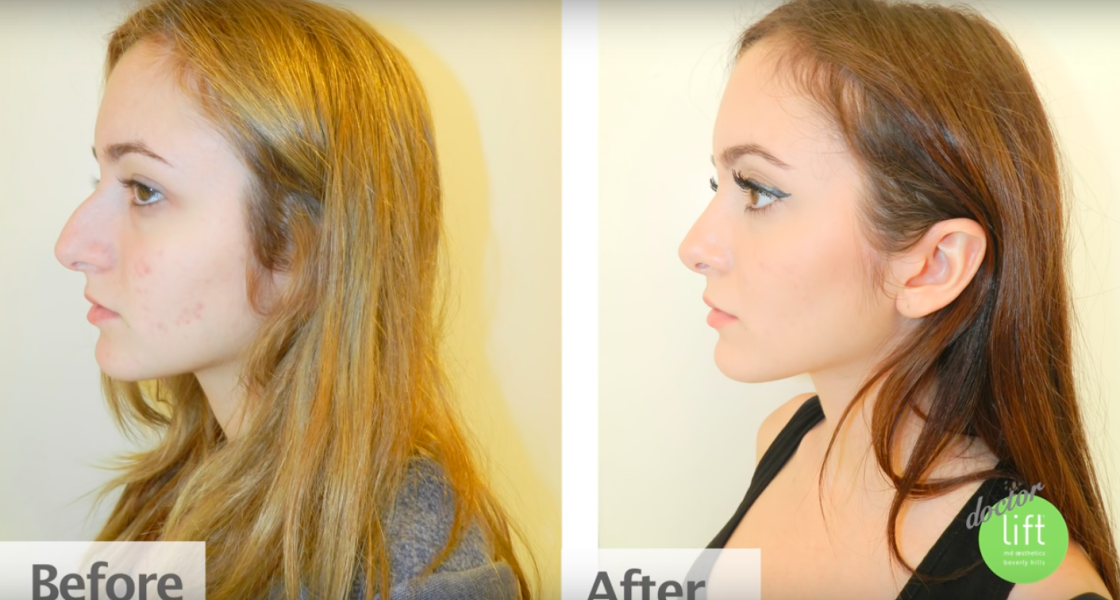 Rhinoplasty