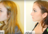 Rhinoplasty