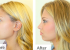 Rhinoplasty