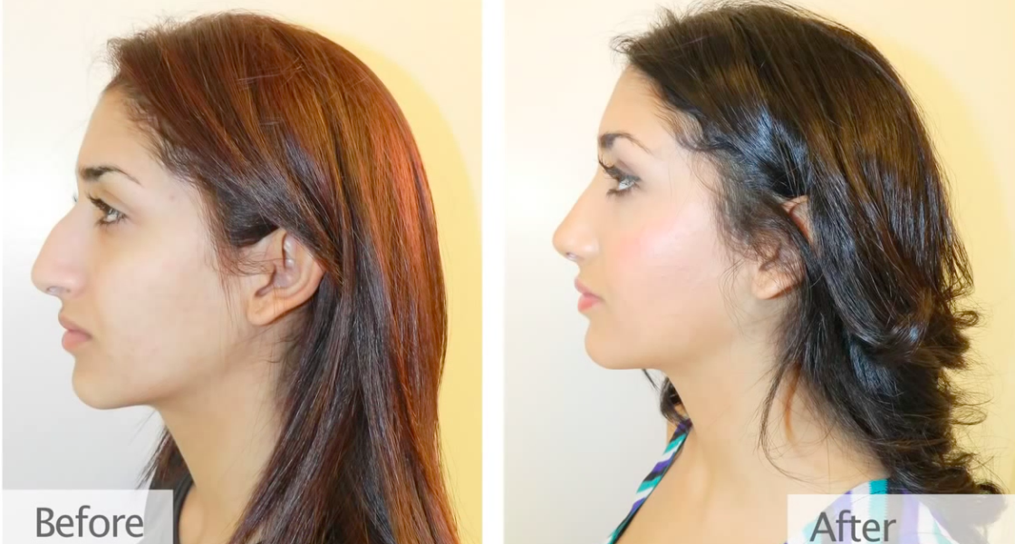 Rhinoplasty