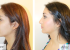 Rhinoplasty