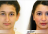 Rhinoplasty