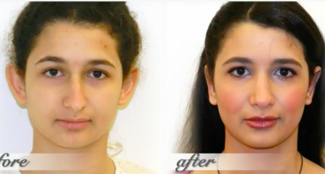 Rhinoplasty