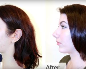 Lilly: Rhinoplasty & Chin Implant Patient Transformation by Dr. Garo Kassabian