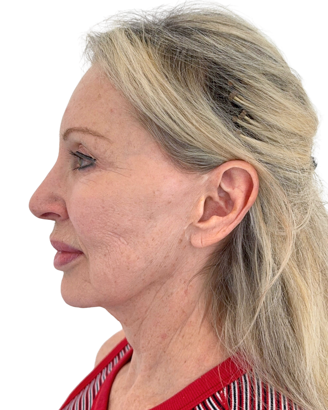 BEFORE FACE + NECKLIFT