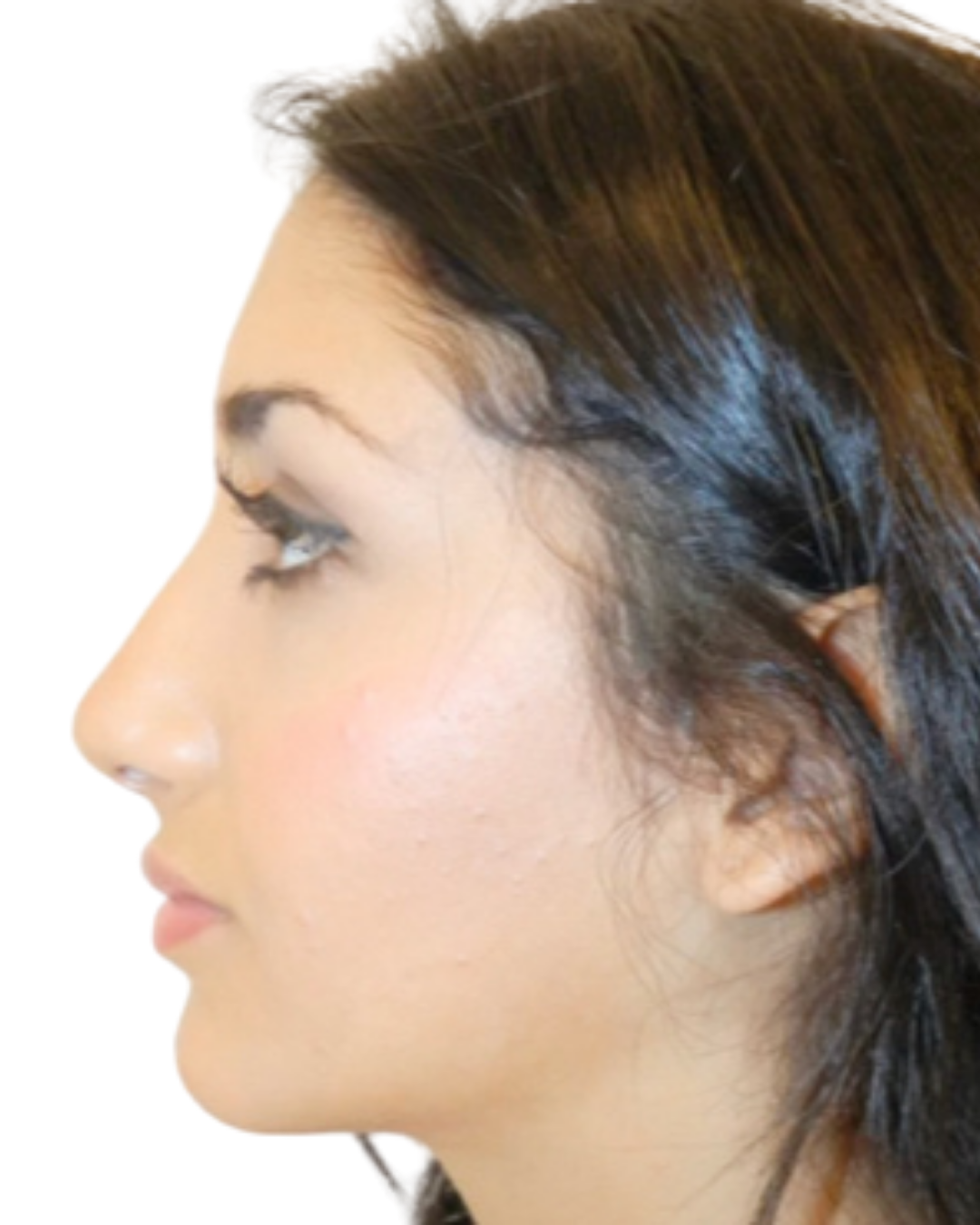 After Rhinoplasty by Dr. Garo Kassabian