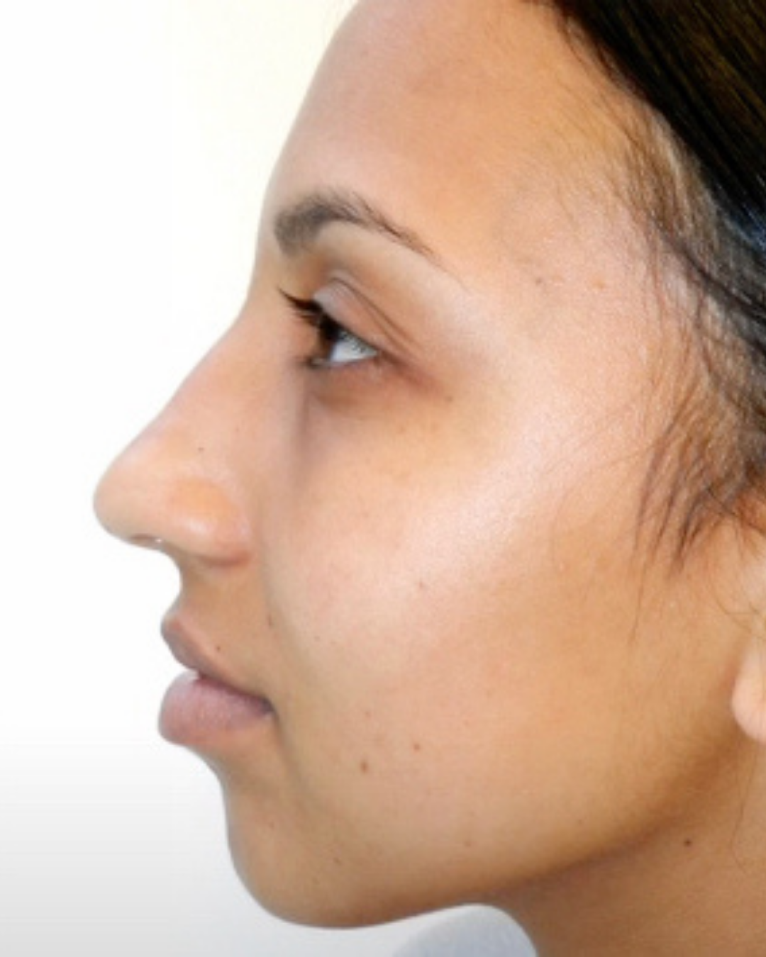 BEFORE RHINOPLASTY