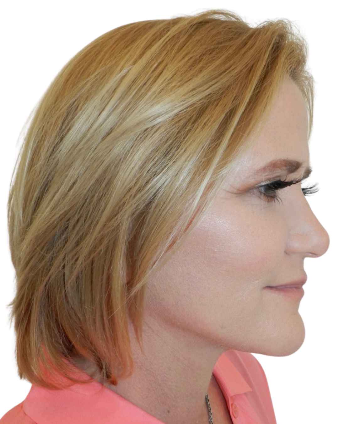 AFTER FACE + NECKLIFT
