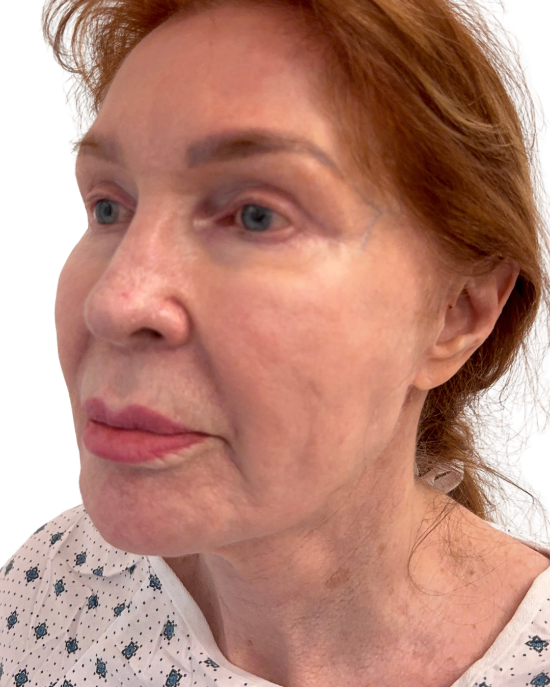 BEFORE FACE + NECKLIFT
