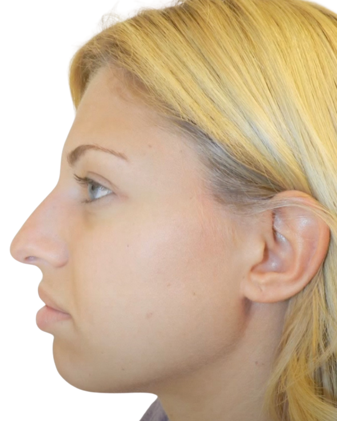 Before Rhinoplasty by Dr. Garo Kassabian