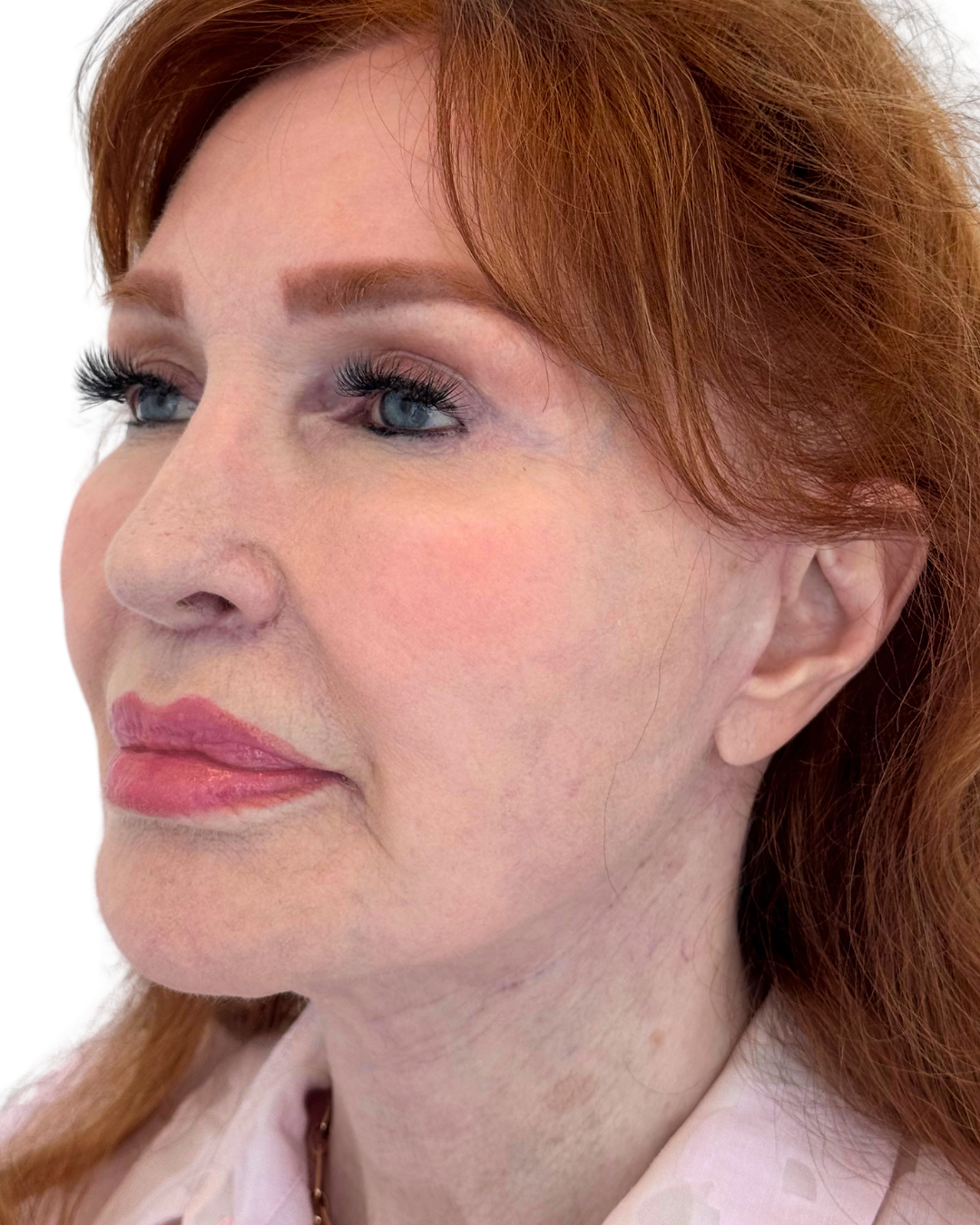 AFTER FACE + NECKLIFT