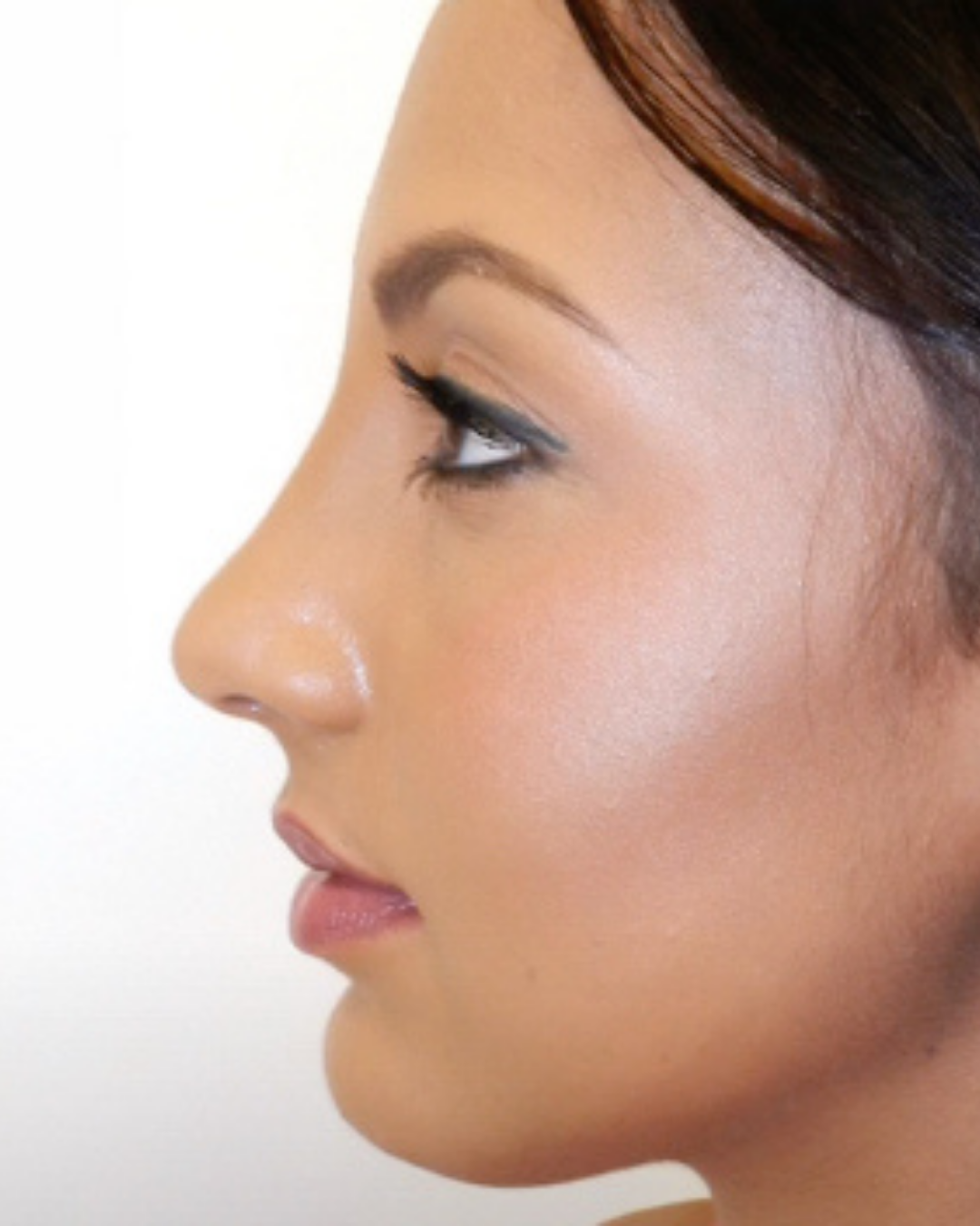 AFTER RHINOPLASTY BY GARO KASSABIAN, MD, FACS