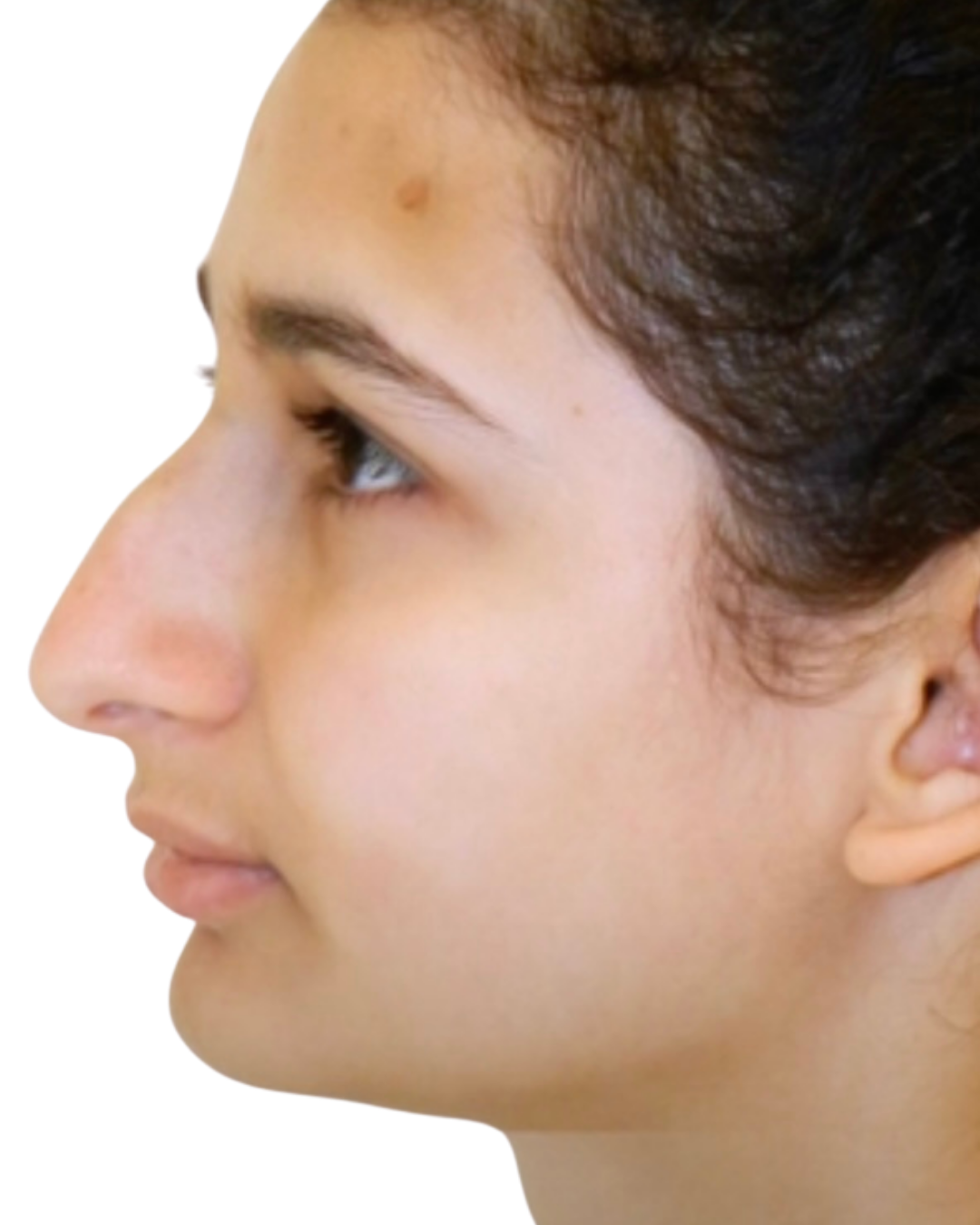 BEFORE RHINOPLASTY