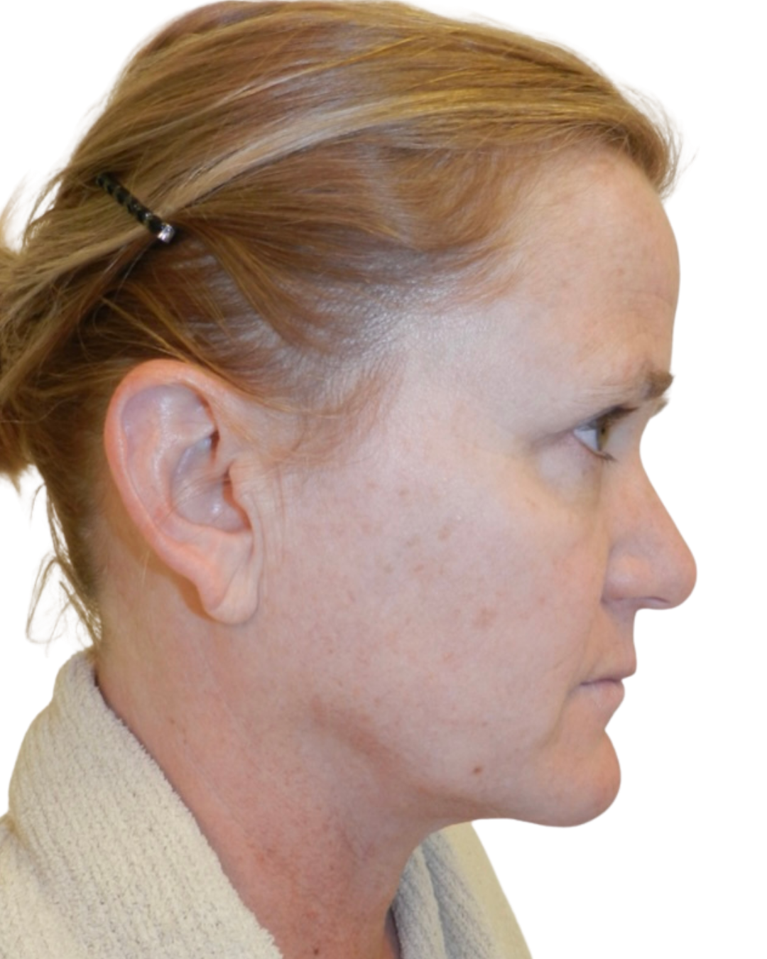 BEFORE FACE + NECKLIFT