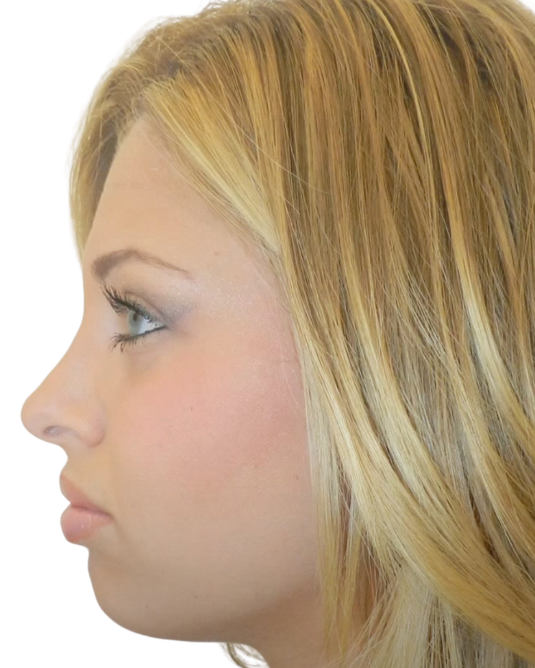 After Rhinoplasty by Dr. Garo Kassabian