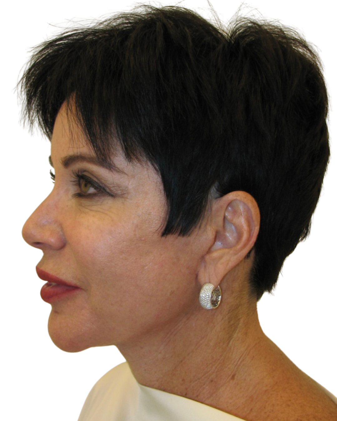 AFTER FACE + NECKLIFT