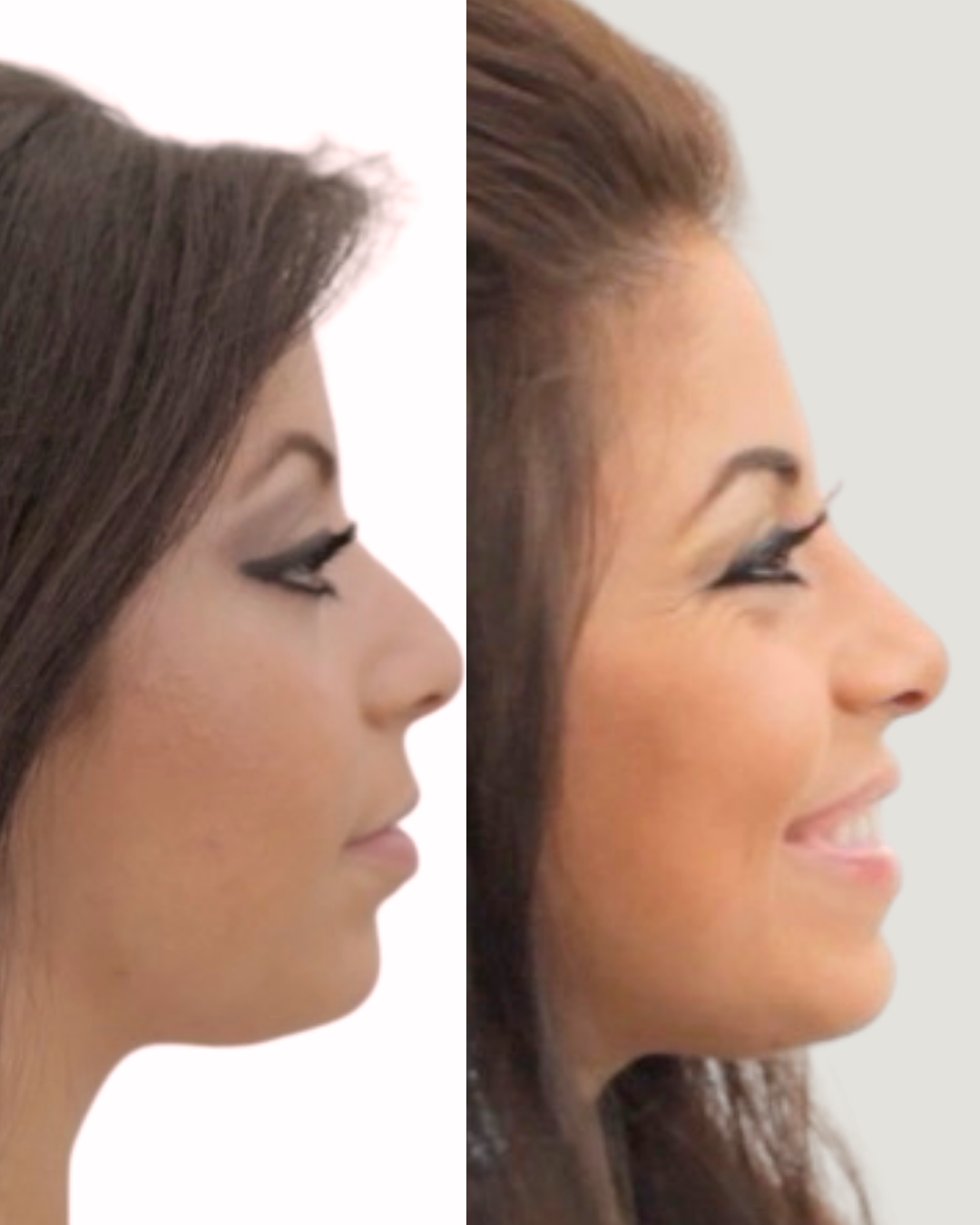 Real Rhinoplasty Patient by Dr. Garo Kassabian