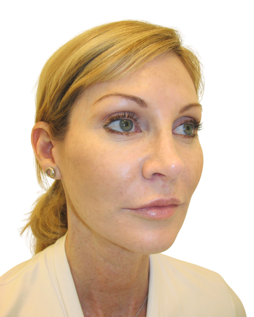 AFTER FACELIFT