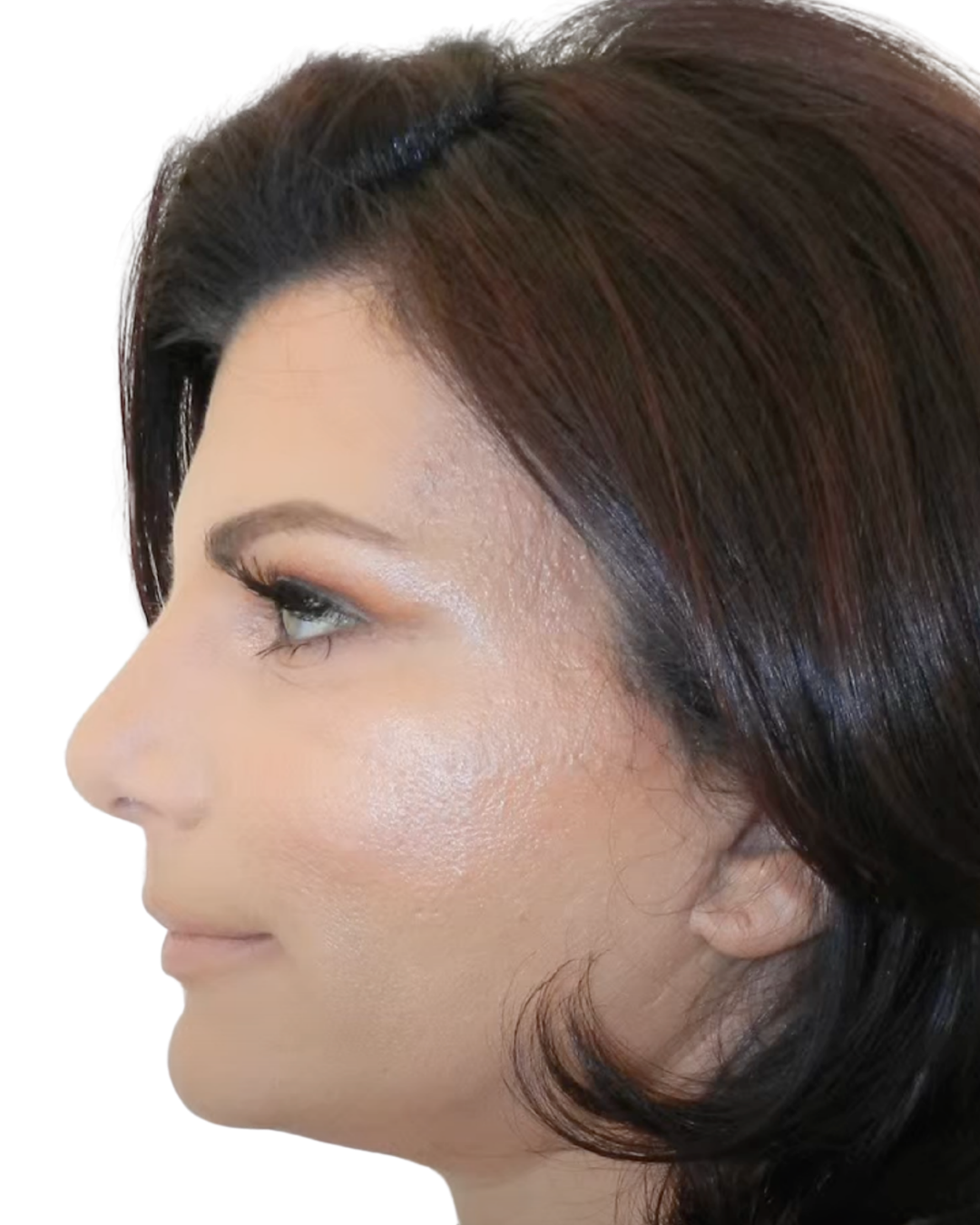 AFTER FACE + NECKLIFT