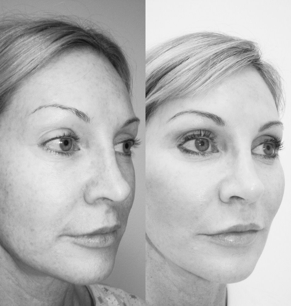 Facelift Beverly Hills