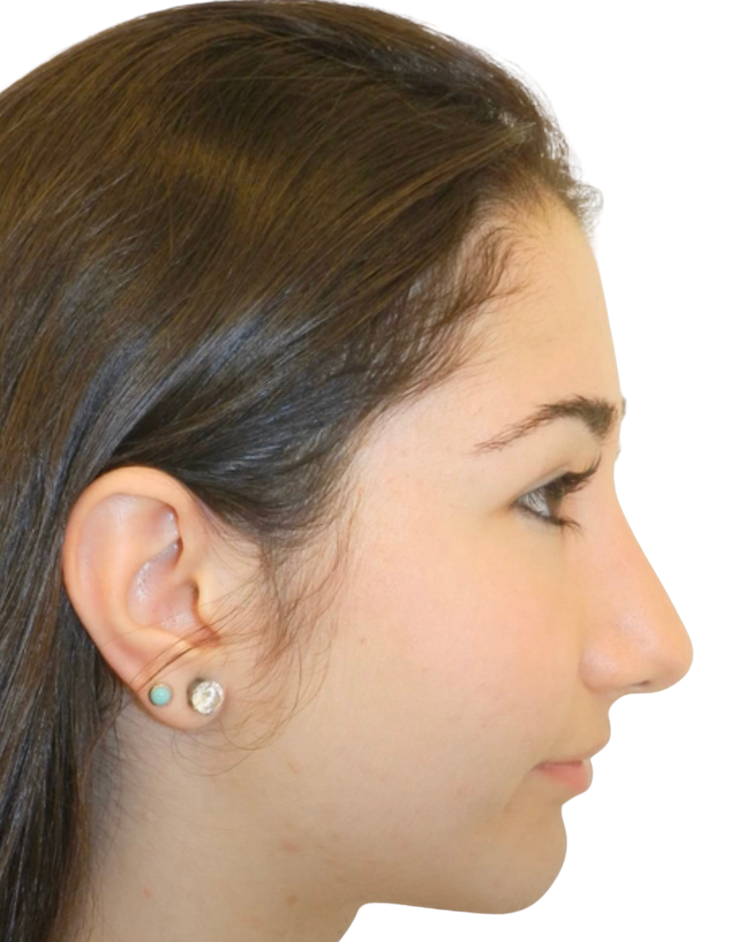 AFTER RHINOPLASTY