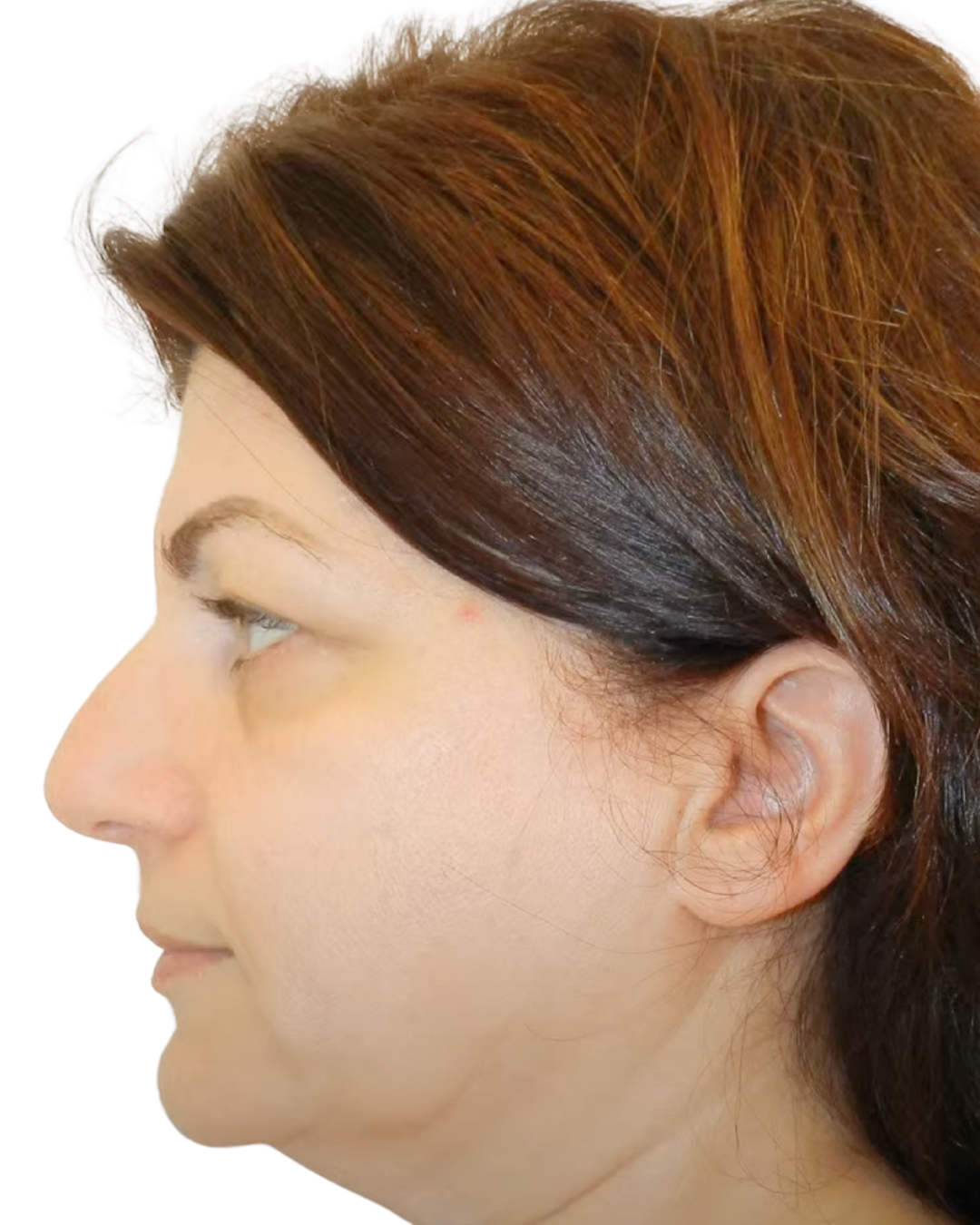 BEFORE FACE + NECKLIFT + RHINOPLASTY