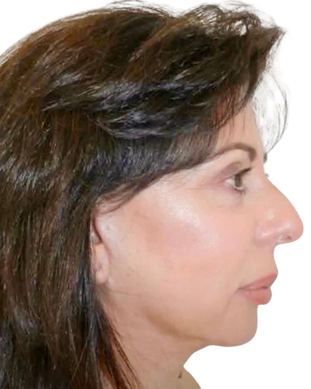 After Facelift and Necklift