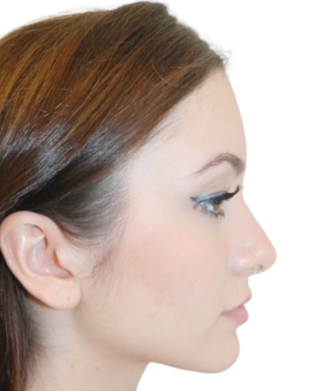 AFTER RHINOPLASTY BY  GARO KASSABIAN, MD, FACS