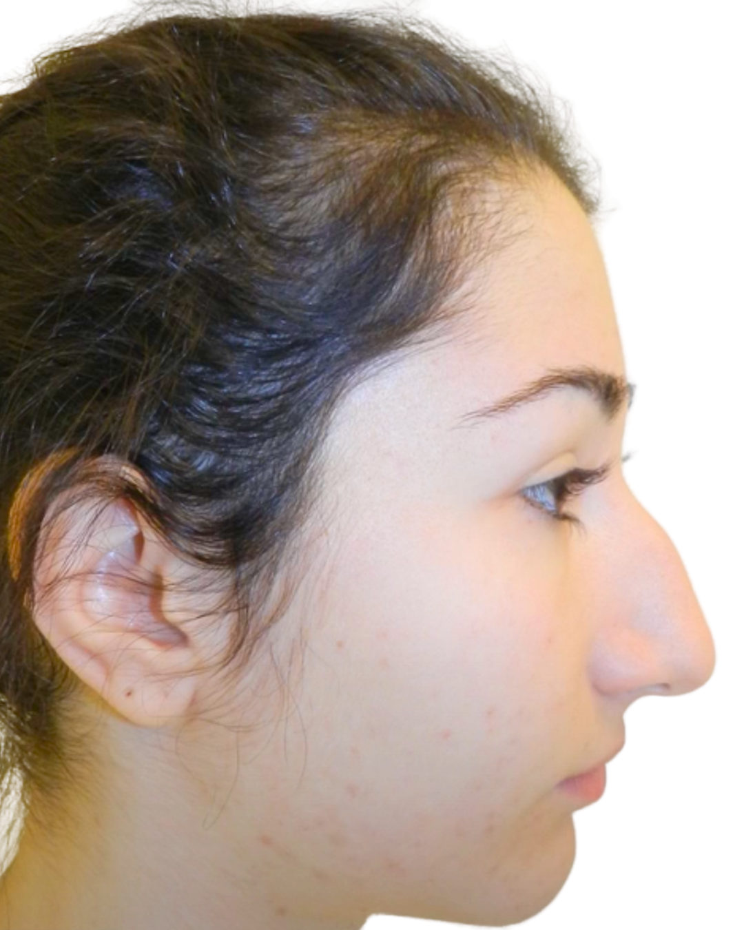 BEFORE RHINOPLASTY