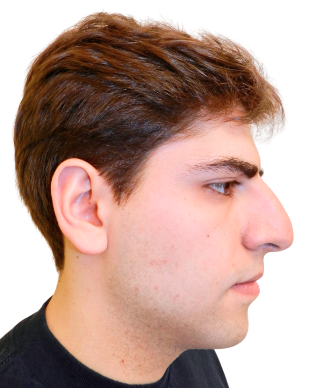 BEFORE RHINOPLASTY