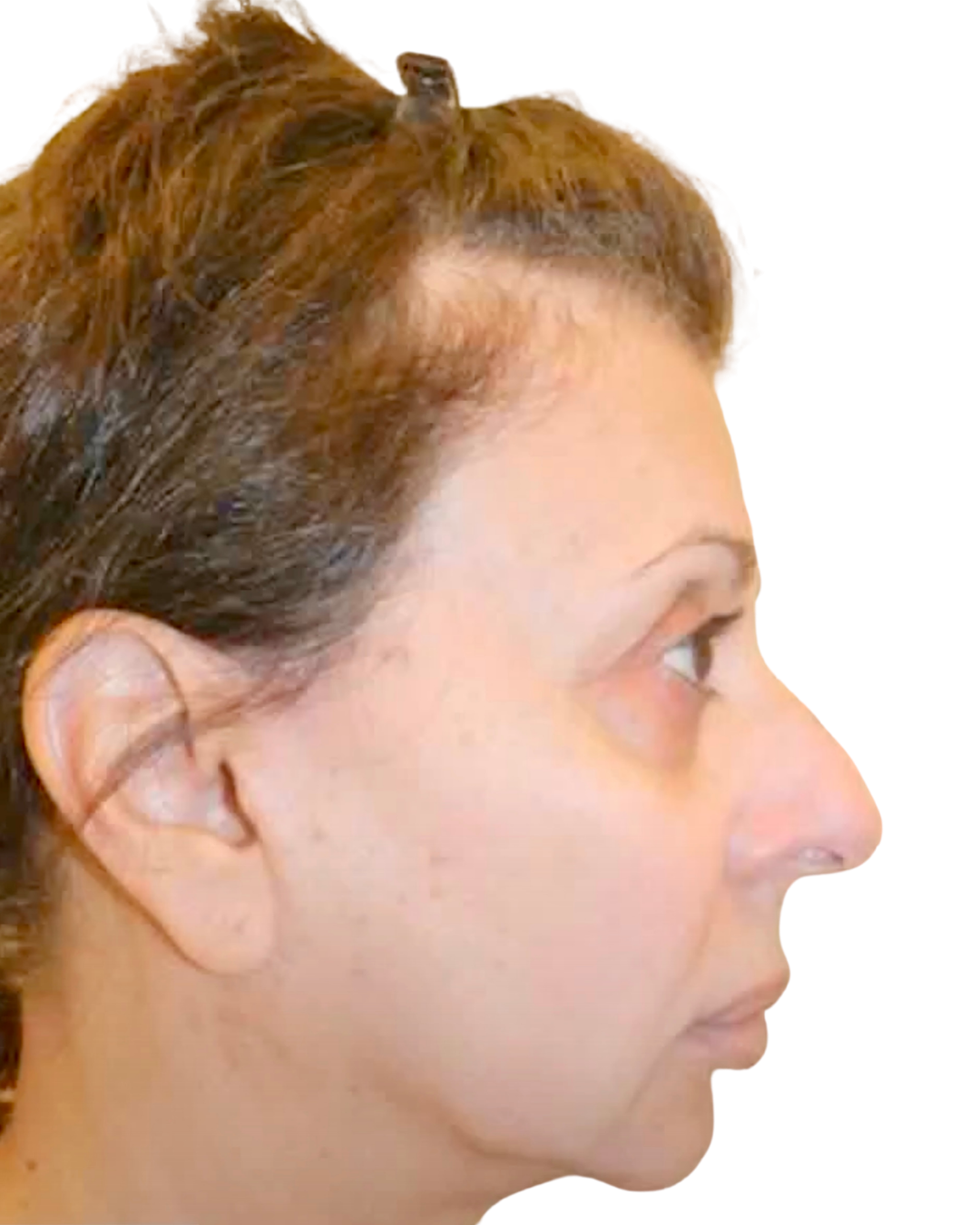Before Facelift