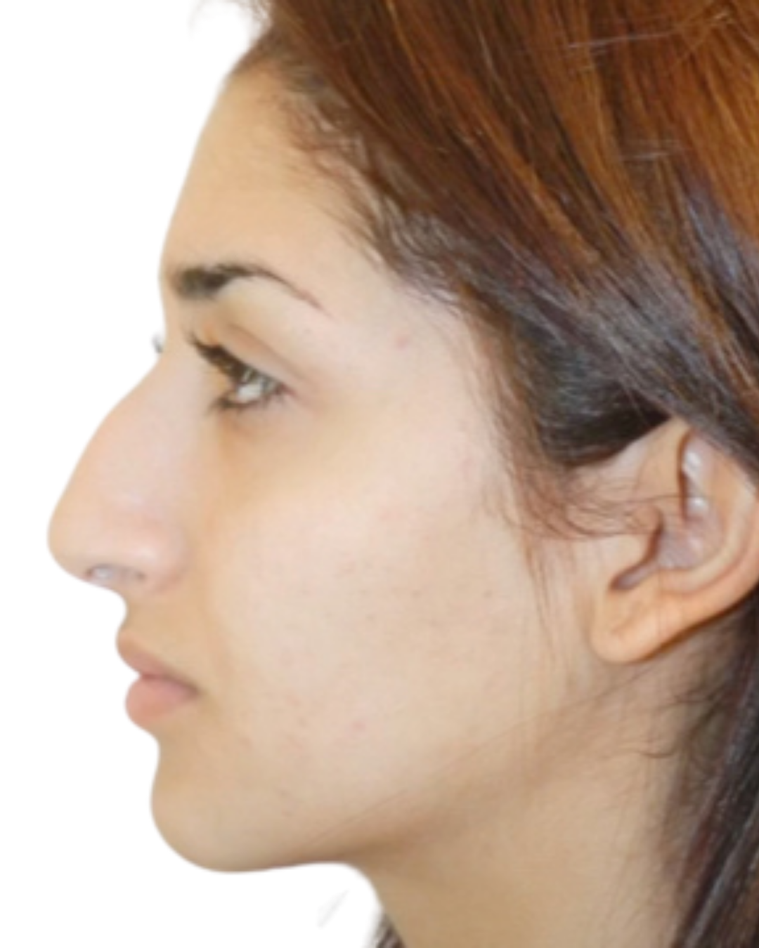 Before Rhinoplasty
