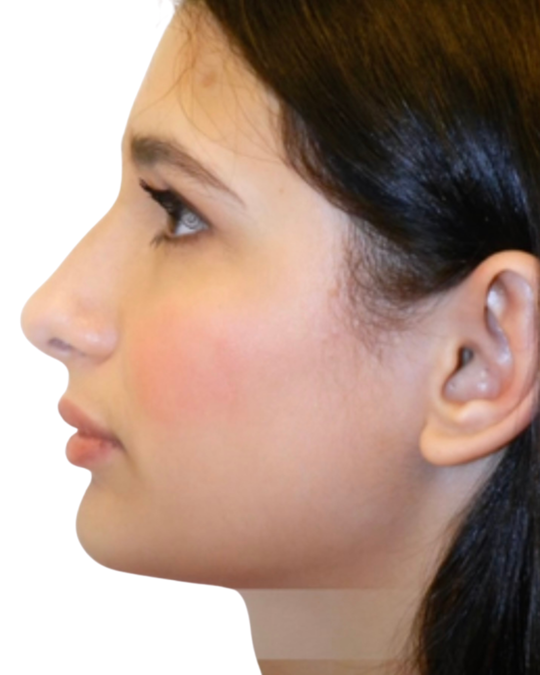 AFTER RHINOPLASTY