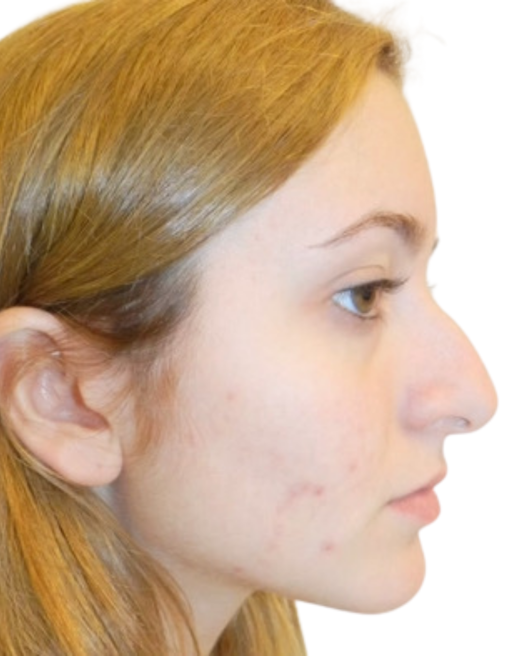 Before Rhinoplasty
