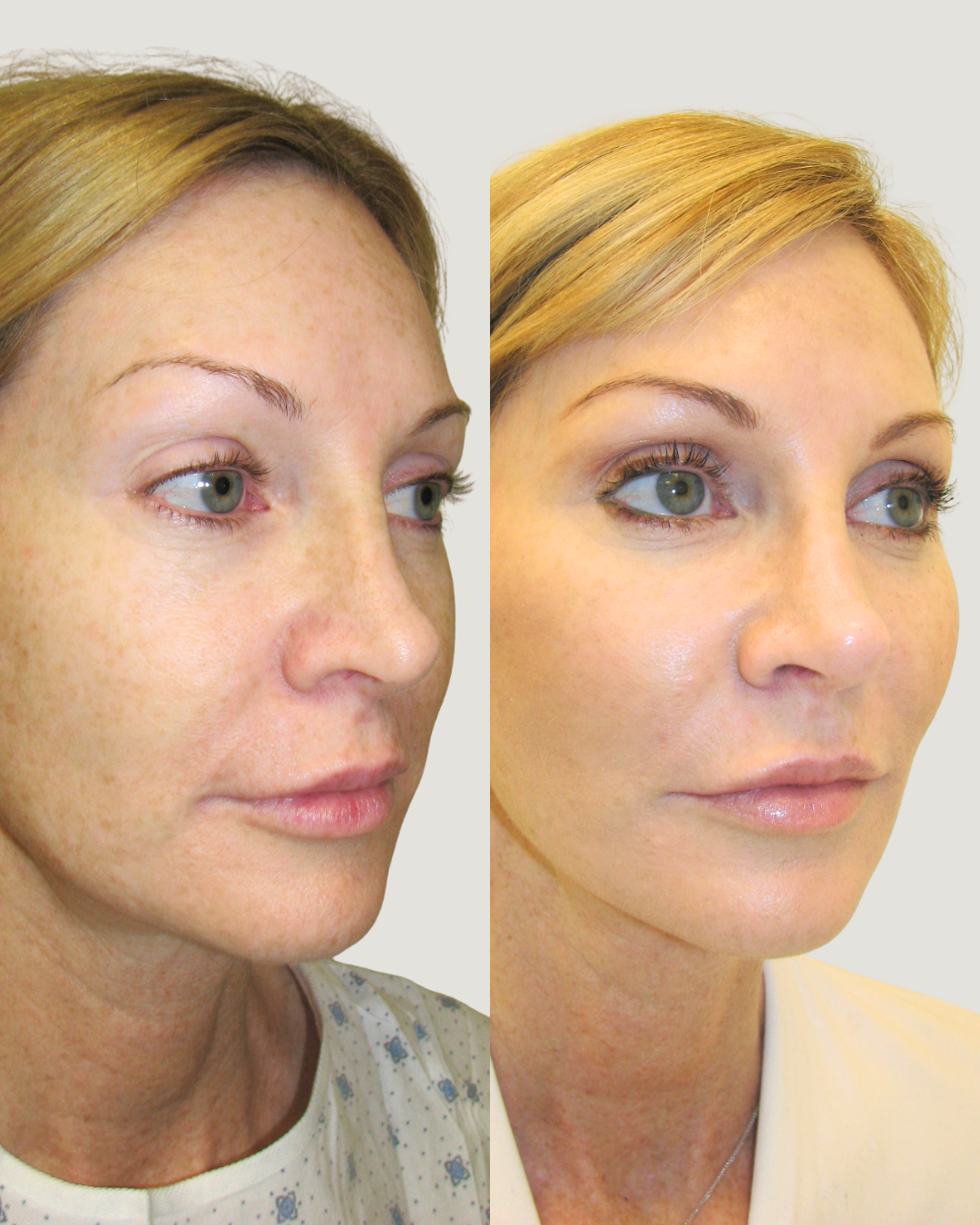 Facelift Beverly Hills