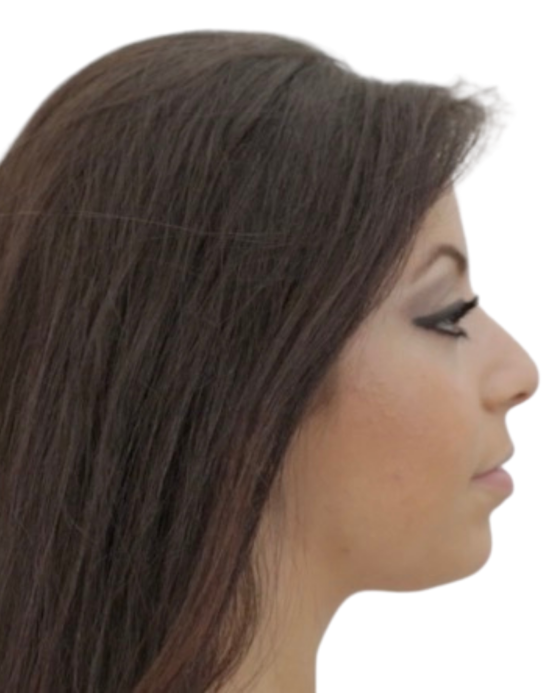 Before Rhinoplasty