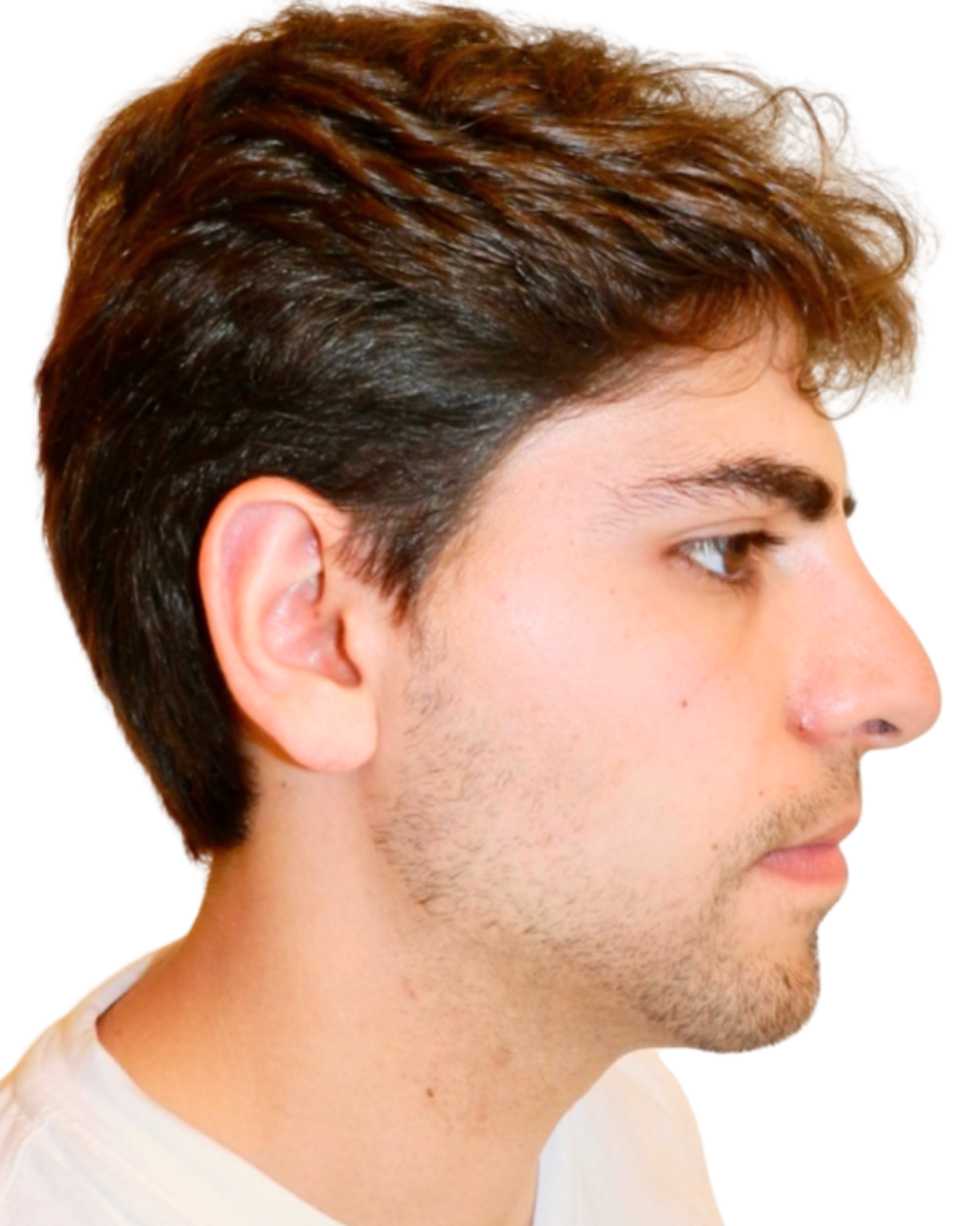 AFTER RHINOPLASTY